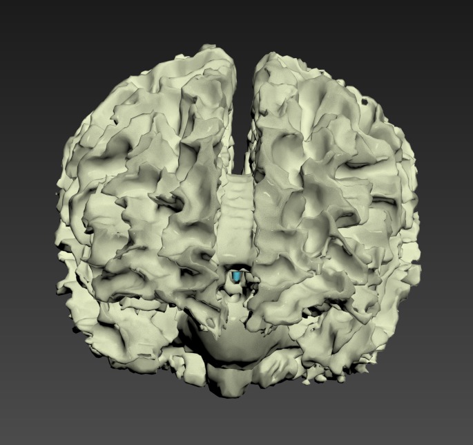 Thumbnail for Head-Brain-White-Matter-Tracts-Lateral-Ventricles