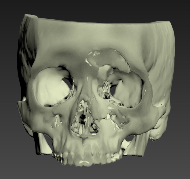 Thumbnail for Head-Frontal-Facial-Skull-Fracture