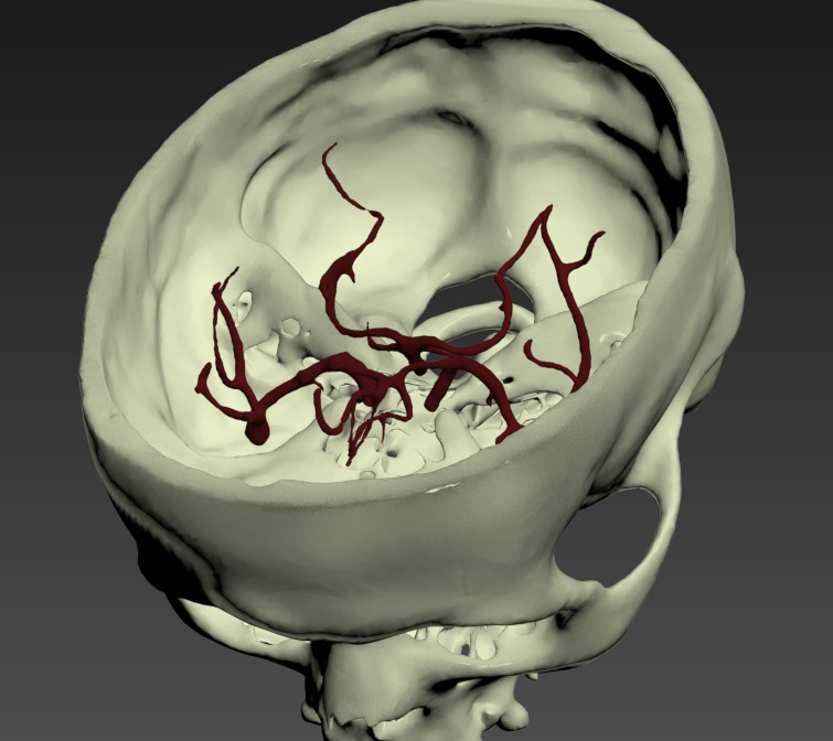 Thumbnail for Head-Middle-Cerebral-Artery-Aneurysm