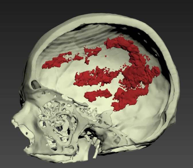 Thumbnail for Head-Subdural-Hematoma