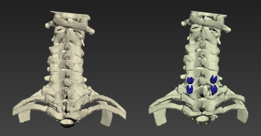 Thumbnail for Neck-Cervical-Spine-Surgery
