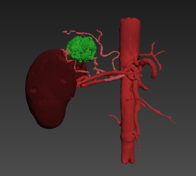 Thumbnail for Torso-Adrenal-Metastatic-Lesion