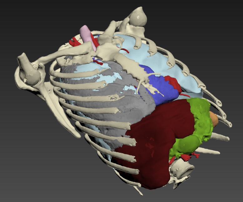 Thumbnail for Torso-Pneumothorax