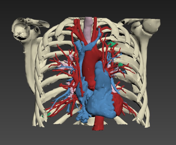 Thumbnail for Torso-Pulmonary-Nodules