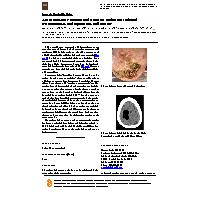 Thumbnail for Acute Tension Pneumatocele …